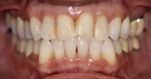 Teeth-1-Before